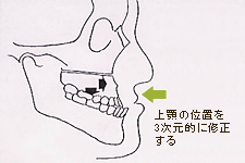 上顎の位置を3次元的に修正する